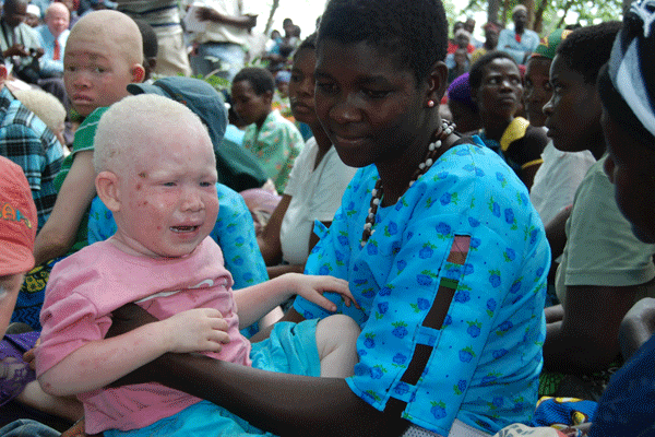 21 persons with albinism killed in Malawi as culture of impunity soars
